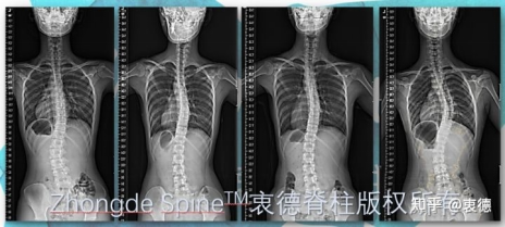 2. Right chest curvature and left waist curvature are more common