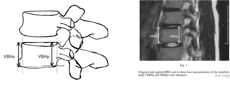 4. In patients with scoliosis, the anterior vertebral body of the spine grows faster than the posterior one