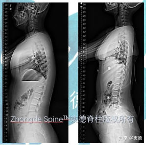 6. Most patients with scoliosis may experience a flat back deformity in the sagittal plane (reduced thoracic kyphosis)