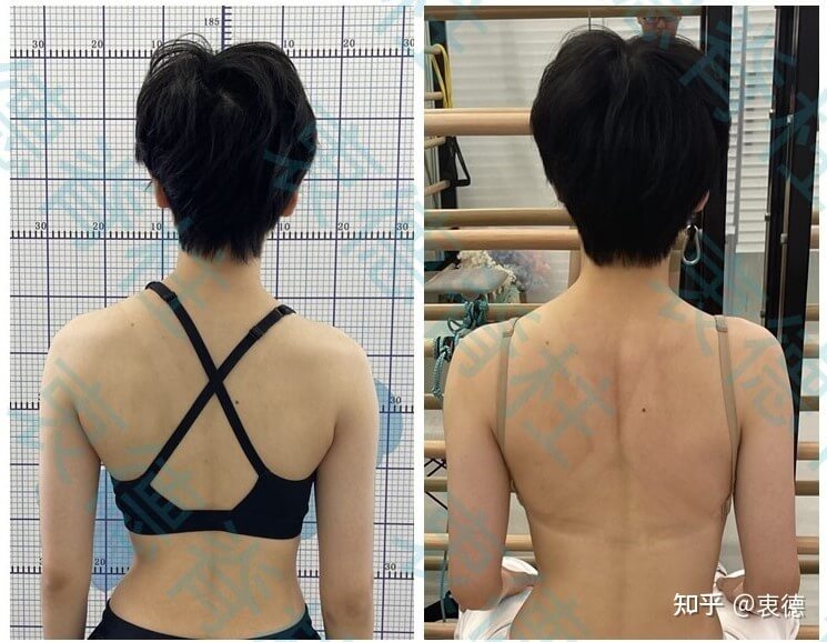 How to self test for scoliosis?