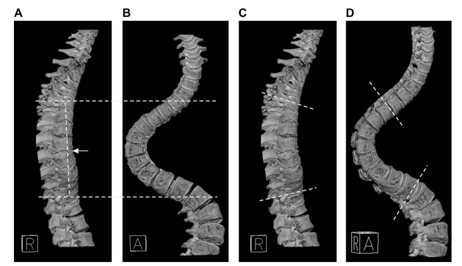 Dr. Yang Zongde's unique insights into the causes of scoliosis