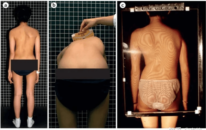 How to self test for scoliosis?