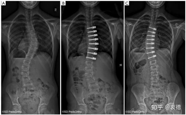 Clarifying the boundaries of one's own abilities -- A reflection on a special case of lateral bending