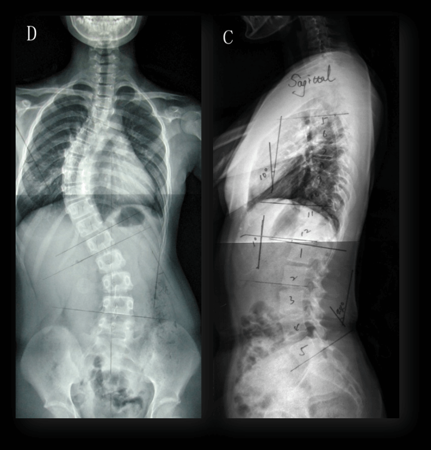 What is the cause of scoliosis?