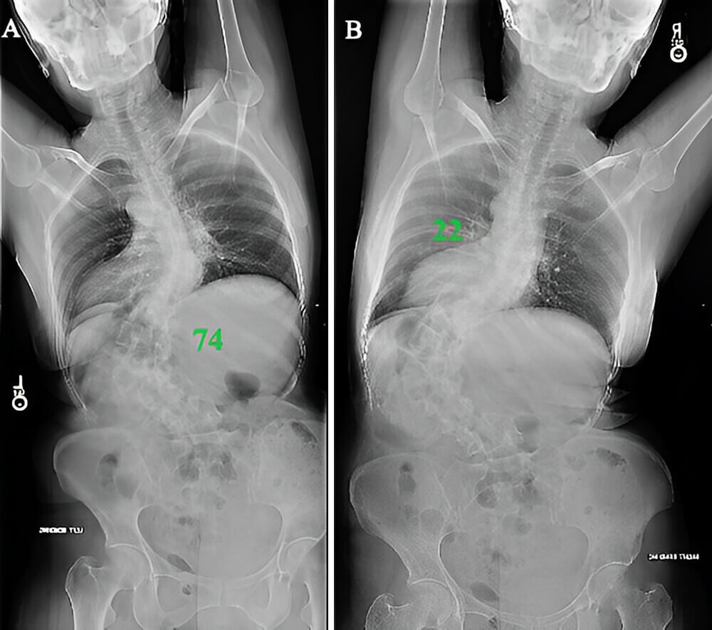 Focral bending slide evaluation