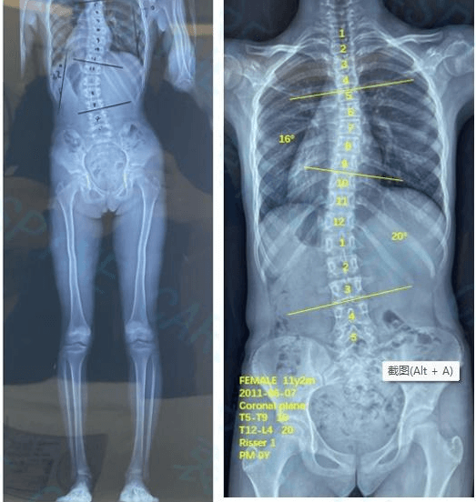 Length of both lower limbs