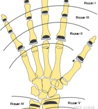 Analysis of hand growth potential using chart method