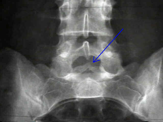 Cleft sacral vertebrae