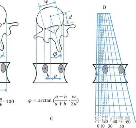 Perdriolle spinal rotation classification