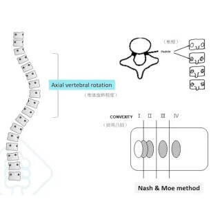 NASH-MOE Spinal Rotation Grading