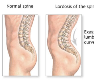 Lumbar lordosis