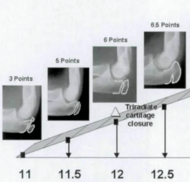 Analysis of ossification degree of ulnar olecranon