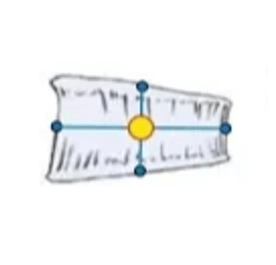 wedging of vertebral body