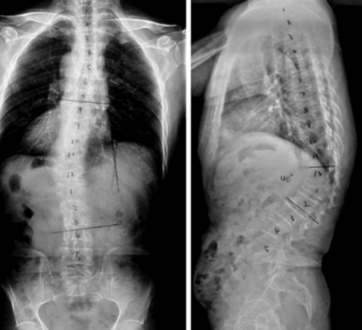 Chest and lumbar kyphosis angle