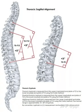 thoracic kyphosis