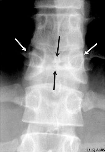 Butterfly vertebrae