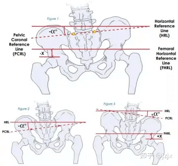 Sagittal plane parameters